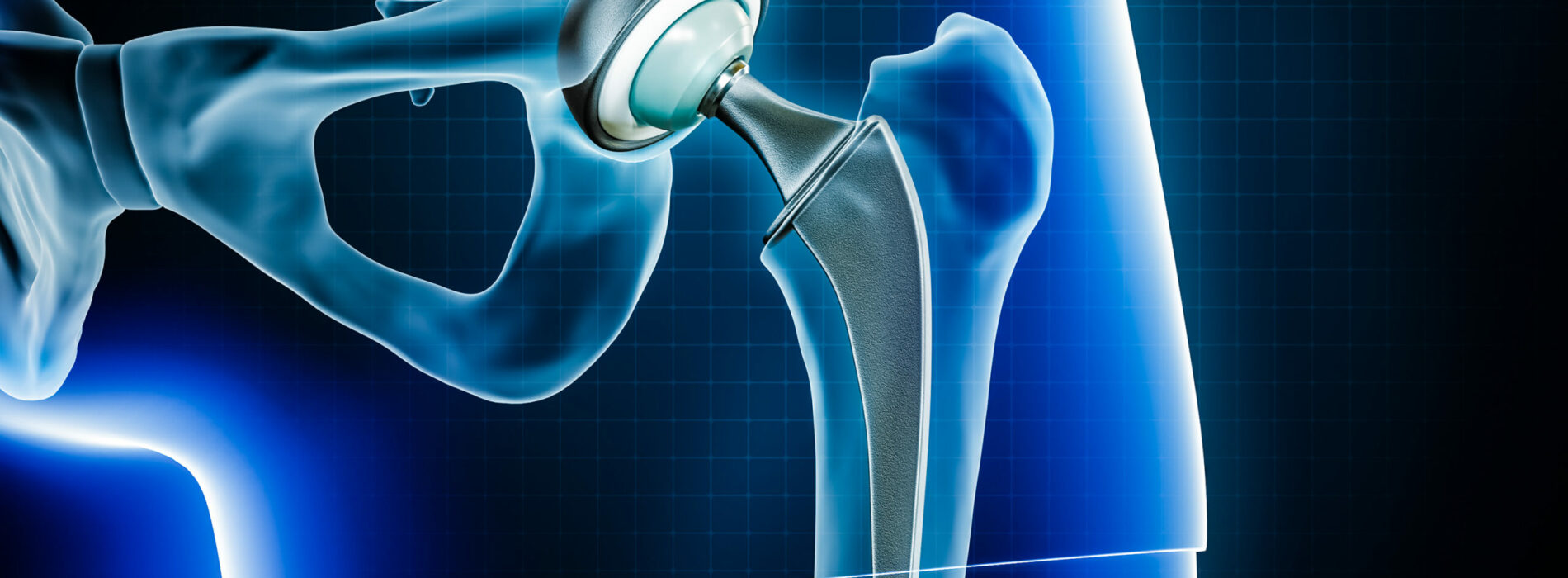 Gdzie najlepiej zrobić endoprotezę stawu biodrowego w Łodzi?
